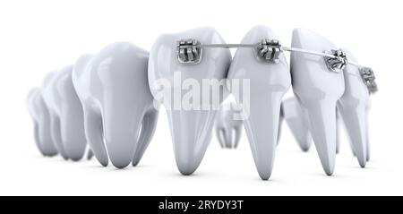 Brackets on the teeth Stock Photo