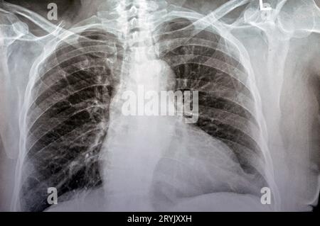 Plain x ray chest of an old woman with almost normal study of bones, lungs and heart, normal chest cavity, ribs and wall, no signs of white patches or Stock Photo