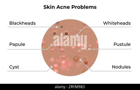 Types of Acne Skin inflammation. Pimples, boils, whitehead, closed ...