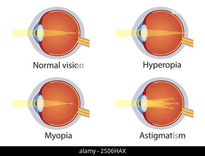 Vector illustration of normal vision and myopia and hyperopia Stock ...