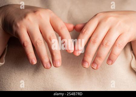 Close up of female hands with dry skin and hangnails. Short fingernails. Cuticles in bad condition. Poor manicure. Stock Photo