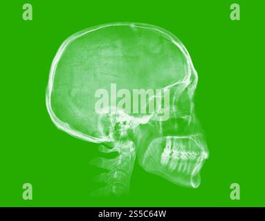 Human skull. X-ray image isolated on green background. Human skull. X-ray image on green background Stock Photo