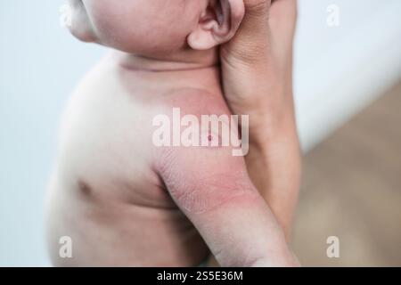 Newborn baby with red spots due to injection Stock Photo - Alamy