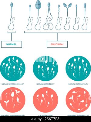 Spermogram. Medical infographic with healthy and damaged spermatozoa birth plan ovulation processes garish vector flat templates. Illustration sperm count, fertility reproduction test. Spermogram. Medical infographic with healthy and damaged spermatozoa birth plan ovulation processes garish vector flat templates Stock Vector