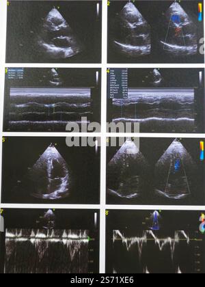 Echocardiography or cardiac ultrasound shows normal values except for ...