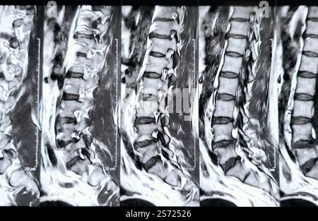 Magnetic Resonance Imaging MRI of the lumbosacral spine shows ...