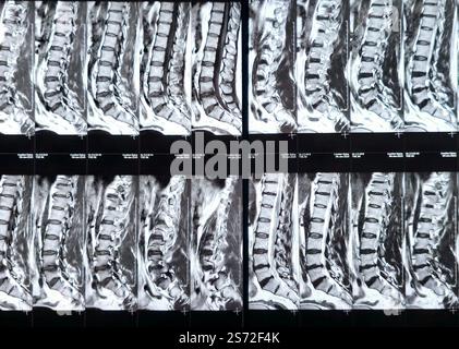 Magnetic Resonance Imaging MRI of the lumbosacral spine shows ...