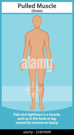 Illustration of muscle strain in human body Stock Vector Image & Art ...