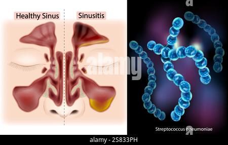 Comparison of Healthy Sinus and Sinusitis with Streptococcus Pyogenes ...