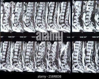 Magnetic Resonance Imaging MRI of the lumbosacral spine shows ...