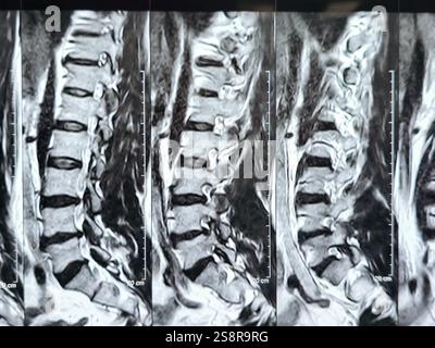Magnetic Resonance Imaging MRI of the lumbosacral spine shows ...