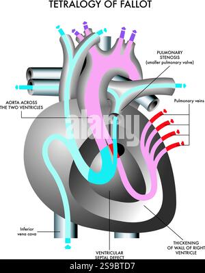 Schematic illustration of the symptoms of Tetralogy of Fallot, a congenital heart defect, with annotations. Stock Vector