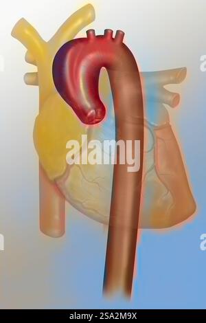 Aneurysm of the ascending thoracic aorta (aortic arch Stock Photo - Alamy