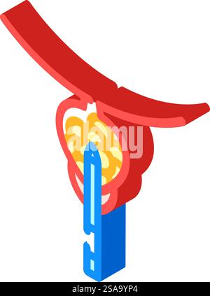 transurethral resection prostate surgery color icon vector ...