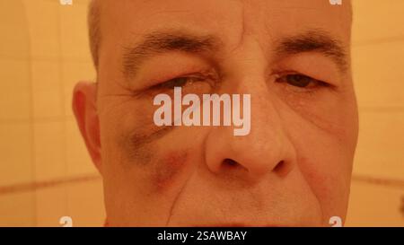 The face of a man with a black eye. Bruise on the face of an elderly man. Concept of aggression, violence, cruelty and domestic violence. Close-up Stock Photo
