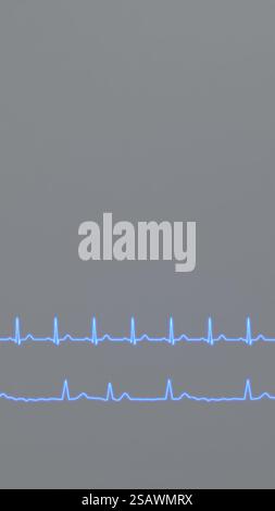 Comparison of ECG of normal heart rhythm and tachycardia Stock Photo ...