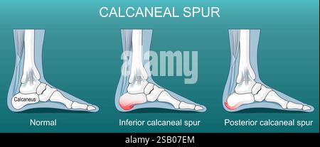 Calcaneal spur. Osteophytes on the posterior and inferior aspects of the calcaneus. Heel spur. Plantar fasciitis. Achilles tendinopathy. Heel pain. Fo Stock Vector