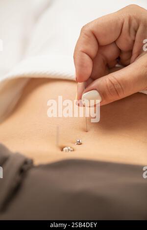 Acupuncture for oedema (fluid retention). Stock Photo