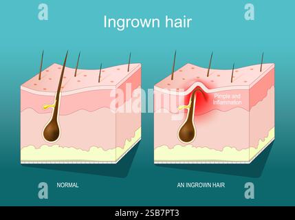 Ingrown hair. Close-up of a hair follicle. Cross section of human skin with Inflamed follicle and Red pimple. Vector poster. Isometric Flat illustrati Stock Vector