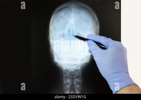 Close-up of a male doctor pointing at the x-ray image of the nose in the office in a hospital. Stock Photo