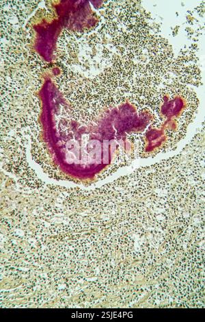 Bacterial disease under the microscope 100x Stock Photo - Alamy