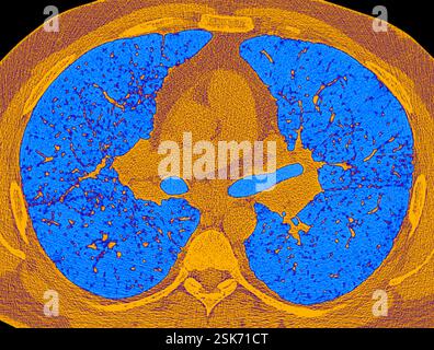 Gaucher's disease, light micrograph Stock Photo