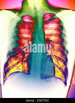 Healthy heart and lungs. Coloured frontal chest X- ray showing a healthy heart (blue, lower centre) and lungs (red/yellow). The heart is a hollow, muscular organ responsible for pumping blood around the body. The blood picks up oxygen from the lungs before returning to the heart to be sent to the rest of the body. These organs are protected by the ribs (horizontal bands) and the sternum (green/blue). Below the heart and lungs is the diaphragm (white), a muscular sheet that contracts and expands, pulling and pushing air in and out of the lungs. Stock Photo