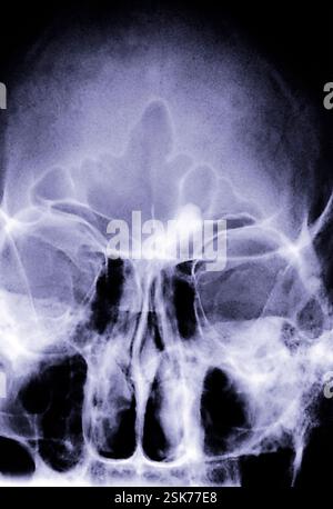 Bony growth in the frontal sinus. X-ray of the head of a patient with an osteoma (bony growth) in the left frontal sinus. This view, from the front, shows the patient's skull. The frontal sinuses are air-filled spaces in the bones of the forehead (upper centre). The left frontal sinus is at upper right, and the bony growth (white) is just above at left of the eye. The eyes are at right and left, and the nose is at lower centre. Any treatment needed will depend on the cause of the oseoma, and how fast it is growing. Stock Photo