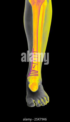 Pinned fractured leg. Coloured X-ray of the lower leg of a 26-year-old male patient with a fractured tibia. The fracture has been reduced (set in correct alignment) using a plate and screws to fix the broken bone in place during healing. Stock Photo