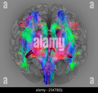 Brain fibres and structures. 3D diffusion tensor imaging (DTI) magnetic resonance imaging (MRI) scan of myelinated white matter nerve pathways in a normal brain, seen from the front (anterior view). Also shown here is an overlay of the brain surface, the brain ventricles (purple) and the thalamus (pink). Diffusion tensor imaging measures the direction of water diffusion, which in the brain reveals the orientation of nerve fibres. The technique is also known as tractography (tract density imaging), with the resulting image known as a tractogram. Stock Photo