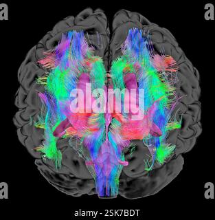 Brain fibres and structures. 3D diffusion tensor imaging (DTI) magnetic resonance imaging (MRI) scan of myelinated white matter nerve pathways in a normal brain, seen from the front (anterior view). Also shown here is an overlay of the brain surface, the brain ventricles (purple) and the thalamus (pink). Diffusion tensor imaging measures the direction of water diffusion, which in the brain reveals the orientation of nerve fibres. The technique is also known as tractography (tract density imaging), with the resulting image known as a tractogram. Stock Photo