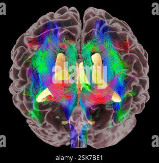 Brain fibres and structures. 3D diffusion tensor imaging (DTI) magnetic resonance imaging (MRI) scan of myelinated white matter nerve pathways in a normal brain, seen from the front (anterior view). Also shown here is an overlay of the brain surface, the brain ventricles (orange) and the thalamus (yellow). Diffusion tensor imaging measures the direction of water diffusion, which in the brain reveals the orientation of nerve fibres. The technique is also known as tractography (tract density imaging), with the resulting image known as a tractogram. Stock Photo