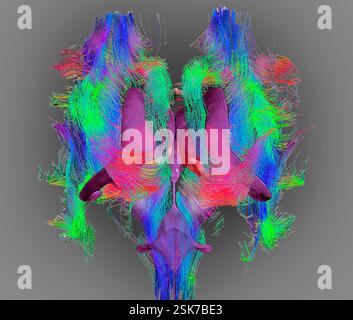 Brain fibres and structures. 3D diffusion tensor imaging (DTI) magnetic resonance imaging (MRI) scan of myelinated white matter nerve pathways in a normal brain, seen from the front (anterior view). Also shown here is an overlay of the brain ventricles (purple) and the thalamus (pink). Diffusion tensor imaging measures the direction of water diffusion, which in the brain reveals the orientation of nerve fibres. The technique is also known as tractography (tract density imaging), with the resulting image known as a tractogram. Stock Photo