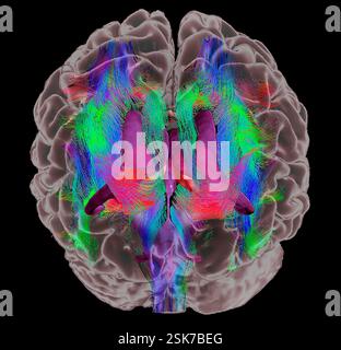 Brain fibres and structures. 3D diffusion tensor imaging (DTI) magnetic resonance imaging (MRI) scan of myelinated white matter nerve pathways in a normal brain, seen from the front (anterior view). Also shown here is an overlay of the brain surface, the brain ventricles (purple) and the thalamus (pink). Diffusion tensor imaging measures the direction of water diffusion, which in the brain reveals the orientation of nerve fibres. The technique is also known as tractography (tract density imaging), with the resulting image known as a tractogram. Stock Photo