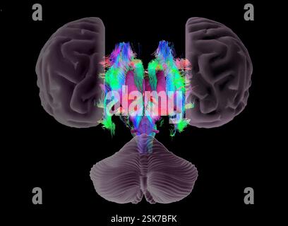 Brain fibres and structures. 3D diffusion tensor imaging (DTI) magnetic resonance imaging (MRI) scan of myelinated white matter nerve pathways in a normal brain, seen from the front (anterior view) in exploded form. Also shown here is an overlay of the brain surface, the cerebellum (bottom) and the brain ventricles (purple) and thalamus (pink). Diffusion tensor imaging measures the direction of water diffusion, which in the brain reveals the orientation of nerve fibres. The technique is also known as tractography (tract density imaging), with the resulting image known as a tractogram. Stock Photo