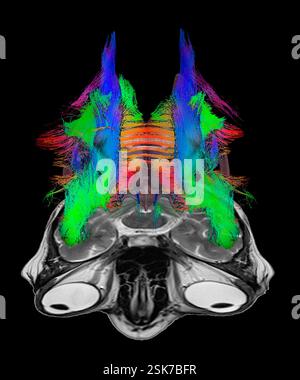 Brain fibres and eyeballs. 3D diffusion tensor imaging (DTI) magnetic resonance imaging (MRI) scan of myelinated white matter nerve pathways in a normal brain, seen from the front (anterior view). Also shown here is a 2D axial MRI scan through the brain at the level of the eyes (lower centre). Diffusion tensor imaging measures the direction of water diffusion, which in the brain reveals the orientation of nerve fibres. The technique is also known as tractography (tract density imaging), with the resulting image known as a tractogram. Stock Photo