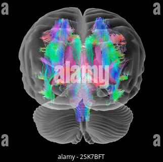 Brain fibres and structures. 3D diffusion tensor imaging (DTI) magnetic resonance imaging (MRI) scan of myelinated white matter nerve pathways in a normal brain, seen from the front (anterior view). Also shown here is an overlay of the brain surface, the cerebellum (bottom) and the brain ventricles (purple) and thalamus (pink). Diffusion tensor imaging measures the direction of water diffusion, which in the brain reveals the orientation of nerve fibres. The technique is also known as tractography (tract density imaging), with the resulting image known as a tractogram. Stock Photo