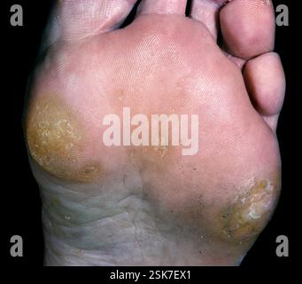 Porokeratosis of Mantoux on the sole of the foot of a 29 year old man. This is a rare, hereditary skin disorder that causes thickened skin on the palms and soles and is more common in males. Porokeratosis of Mantoux can be treated with topical creams and cryotherapy. Stock Photo