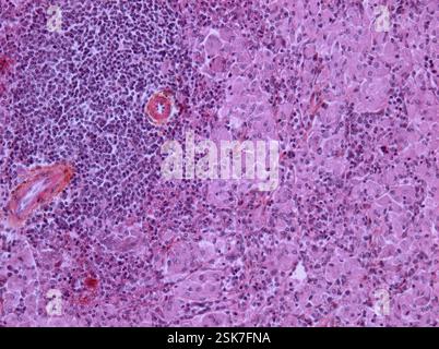 Hodgkin lymphoma recurrence, CT and PET scans Stock Photo