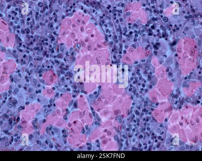 Hodgkin lymphoma, PET and CT-PET scans Stock Photo