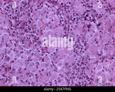 Hodgkin lymphoma recurrence, CT-PET scans Stock Photo