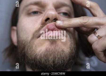 Close-up of a man's face showing a finger touching a cold sore on his lips Stock Photo