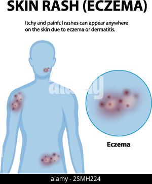 Human Medical Education of Eczema illustration Stock Vector Image & Art ...