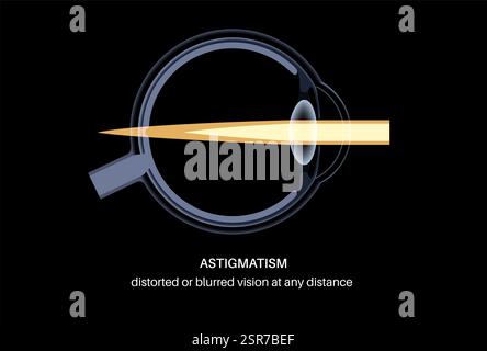 Illustration of the vision of the eye with astigmatism, blurred or ...
