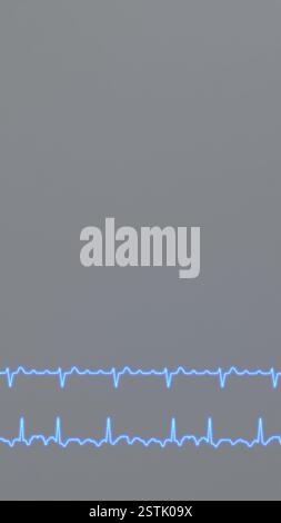 ECG graphs of regular and irregular atrial flutter Stock Photo