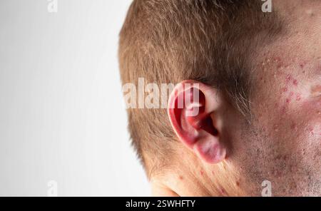 Drinking Rashes Red rashes and spots on the ears and head of a man after drinking ...