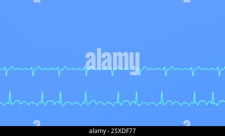 ECG graphs of regular and irregular atrial flutter Stock Photo