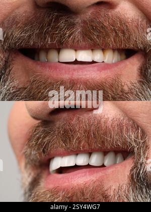 Man smiling before and after procedure dental veneers placement ...