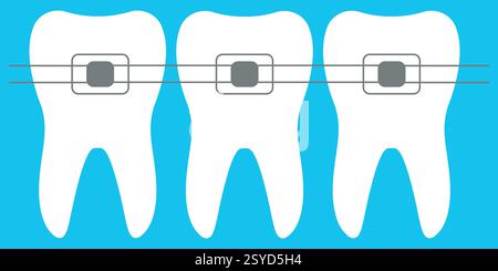 Illustration of Teeth with Braces for Orthodontic Treatment on Blue Background Stock Vector
