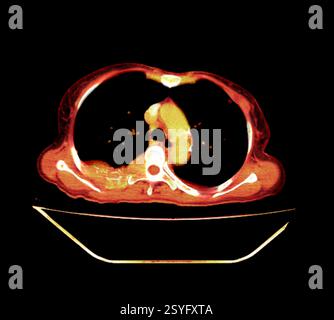 Metastatic bone cancer. Computed tomography (CT) scan of an axial ...